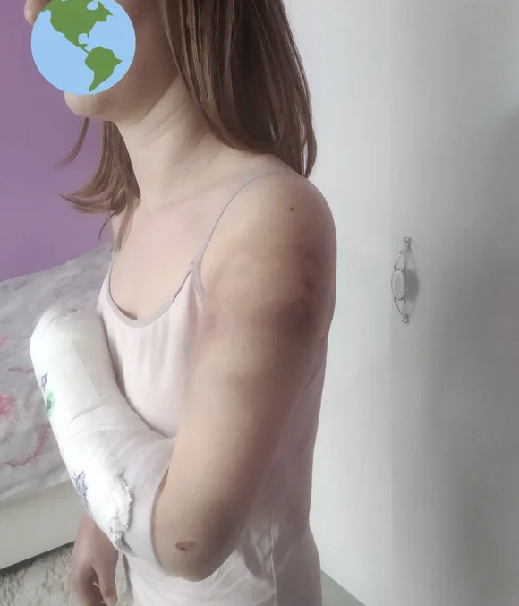 Sevgilisini 'niye bu fotoğrafı beğendin' diye beyzbol sopasıyla hastanelik eden cani tutuklandı - Resim: 2