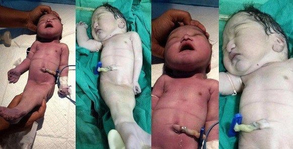 Hindistan'da doğan garip bebek doktorlar cinsiyetini tespit edemedi - Resim: 1