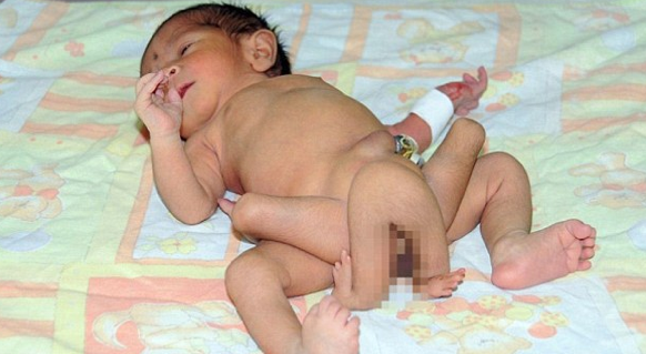 6 bacaklı bebek dehşete düşürdü - Resim: 2