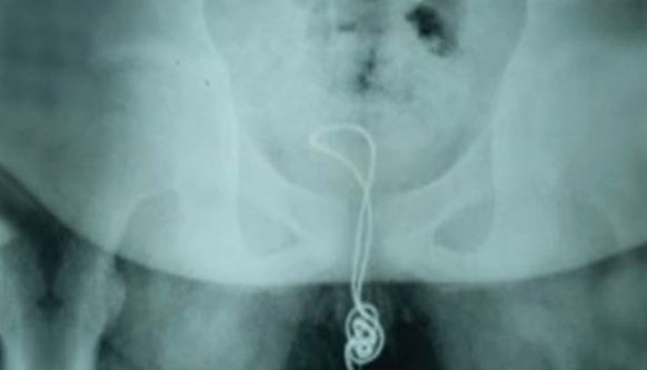 Cinsel organına USB kablosu sıkıştı! Bu kadarına pes - Resim: 3