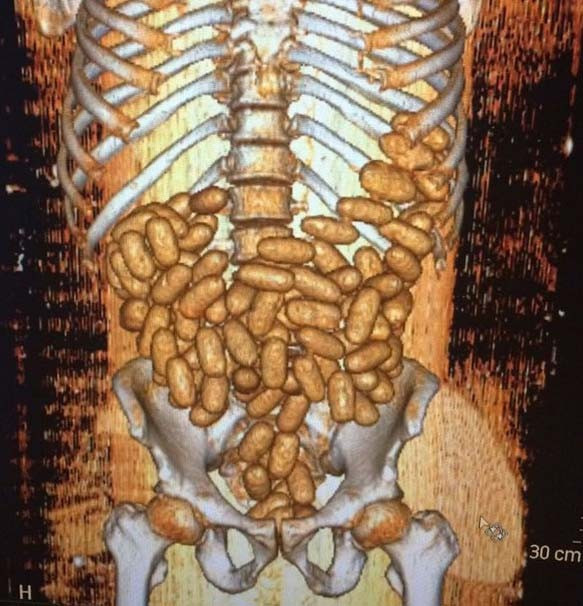 Sindirim sisteminde 115 prezervatif bulundu - Resim: 2