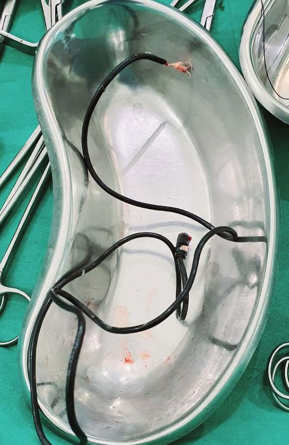 Hindistan’da bir kişinin mesanesinden bir metre uzunluğunda şarj kablosu çıktı - Resim: 0