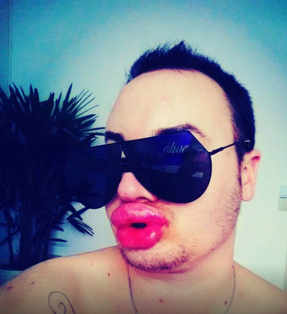 Dudak dolgusu faciası 27 bin lira verdi sonucu şoke etti - Resim: 1