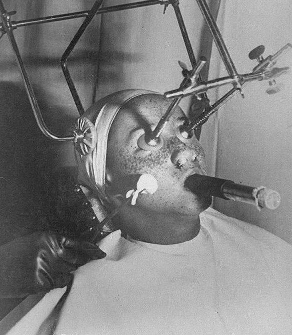 İşkence aleti değil güzellik yöntemi! - Resim: 1