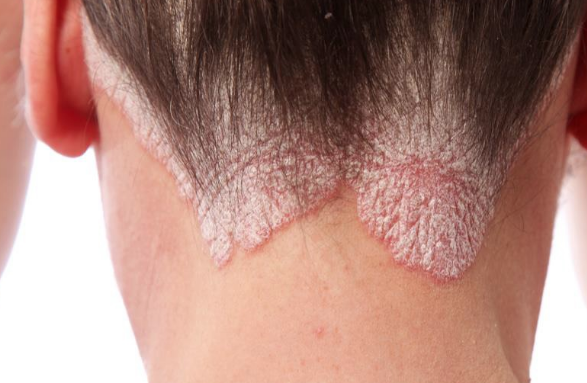 Sedef hastalığı nedir tedavisi var mıdır? - Resim: 4