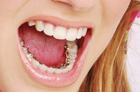 Diş telinden haz etmeyenlere müjde! Bu iki yöntemi deneyin - Resim: 3