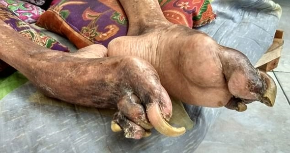 Hayatı bir gecede karardı! Vücudu taşlaşıyor resmen  - Resim: 4