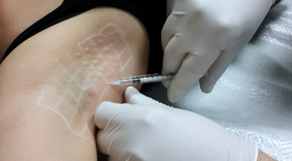 Terleme nasıl geçer? Botoks tedavisi ile aşırı terlemeye son - Resim: 1