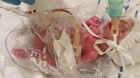 500 gramda doğdu 1 saat yaşamaz denildi son haline bakın - Resim: 4