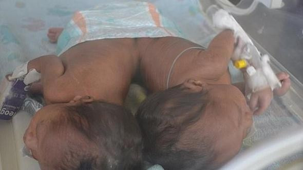 İkizlerin hayatı için büyük mucize tam 50 doktor... - Resim: 1