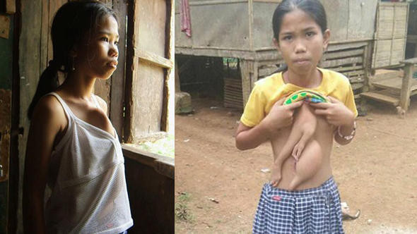 Göğsünde iki kol ile doğdu  şimdi tedavi olmayı bekliyor - Resim: 1