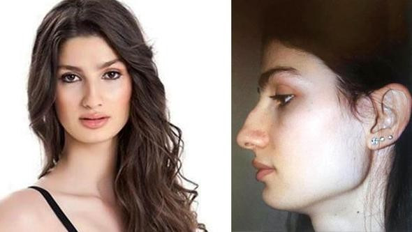 Burun farkıyla 1. demişlerdi estetik yaptırdı - Resim: 1