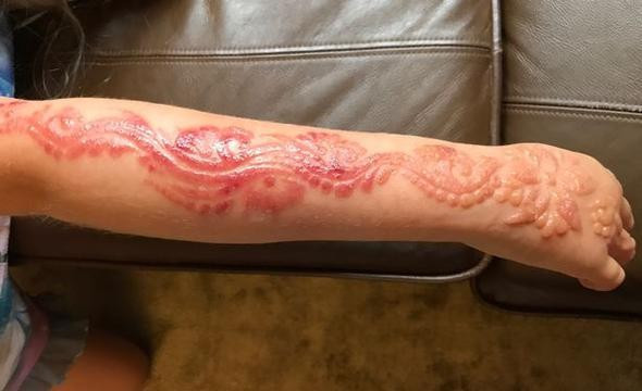 Küçük kızın kolu bu hale geldi hayatı zehir oldu bakın neden - Resim: 4