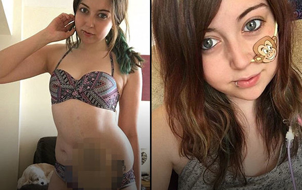 17 yaşında bağırsaklarını aldırdı: Yeni hayatına böyle başladı! - Resim: 1