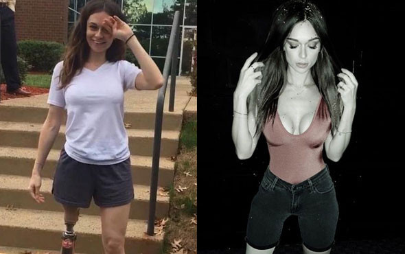 Küçük yaşta kanserden bacağını kaybeden kızın mesleğini duyan şoka uğradı - Resim: 1