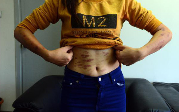 Lazer epilasyon faciası ! Genç kızı resmen yaktılar - Resim: 1