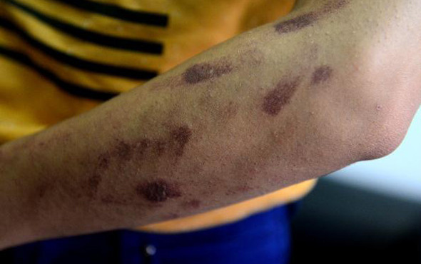 Lazer epilasyon faciası ! Genç kızı resmen yaktılar - Resim: 2