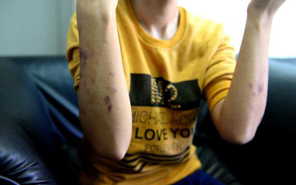 Lazer epilasyon faciası ! Genç kızı resmen yaktılar - Resim: 3