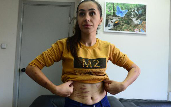 Lazer epilasyon faciası ! Genç kızı resmen yaktılar - Resim: 4