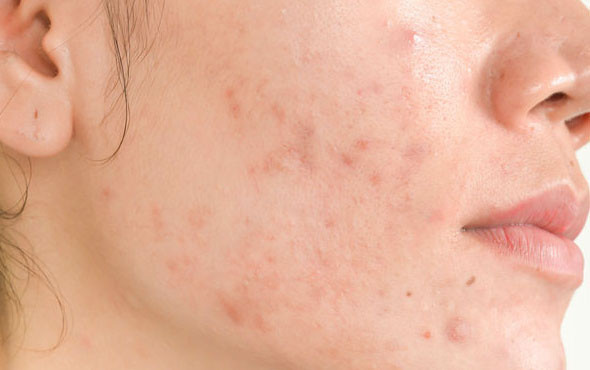 Sivilce lekelerinden kurtulmak için bu doğal yöntemleri deneyin - Resim: 1