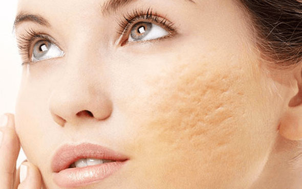 Sivilce lekelerinden kurtulmak için bu doğal yöntemleri deneyin - Resim: 2