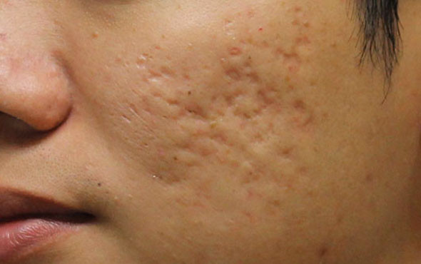 Sivilce lekelerinden kurtulmak için bu doğal yöntemleri deneyin - Resim: 3