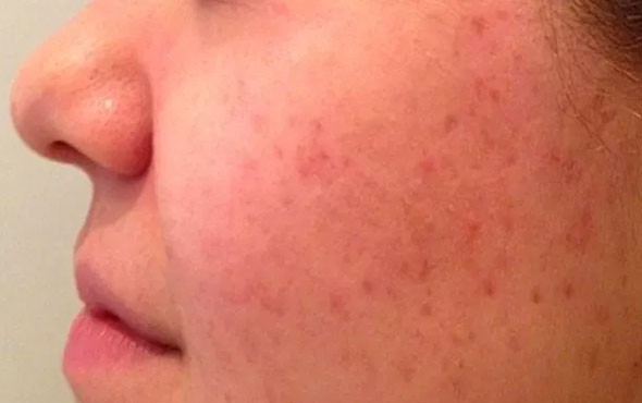 Sivilce lekelerinden kurtulmak için bu doğal yöntemleri deneyin - Resim: 4