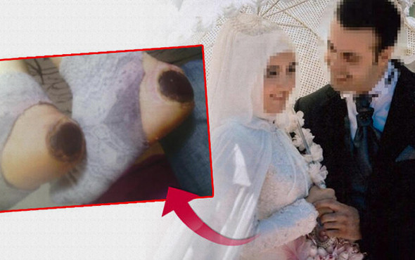 'Topuk yakma' davasında karar! 2 hemşirenin cezası... - Resim: 1