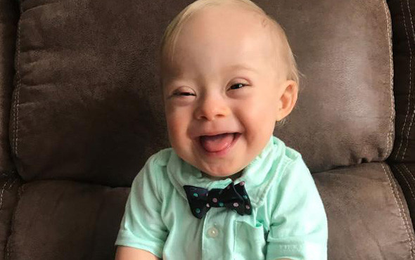 Down Sendromu nedir? 7 soruda bilmeniz gerekenler - Resim: 4