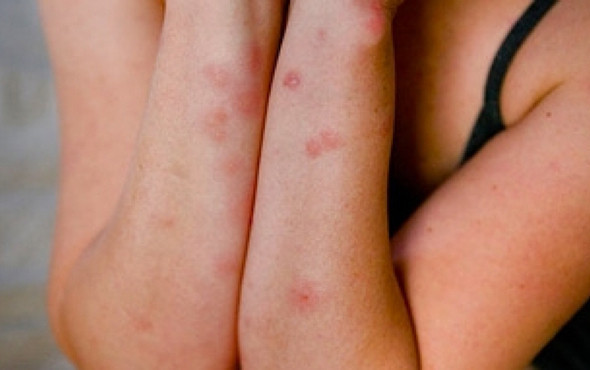 Bu böcek ısırıklarına dikkat! Hangileri tehlikeli - Resim: 1