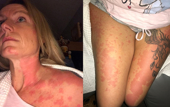 Alkol yüzünden hayatı karardı! Vücudunda yanmayan yer kalmadı - Resim: 2