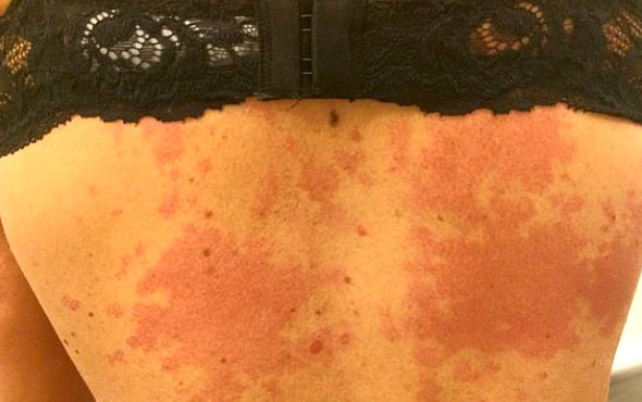 Alkol yüzünden hayatı karardı! Vücudunda yanmayan yer kalmadı - Resim: 3