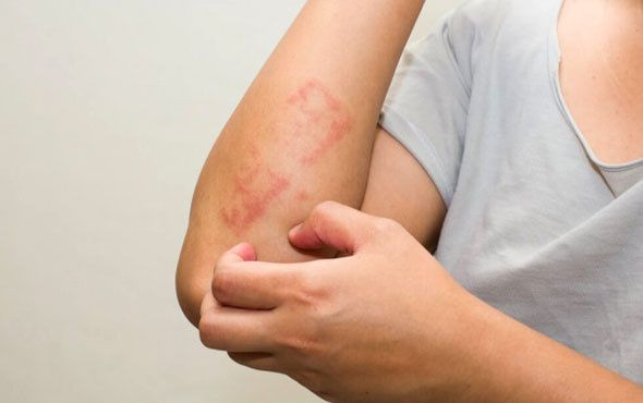 Ürtiker bahar aylarında daha sık görülüyor! - Resim: 3
