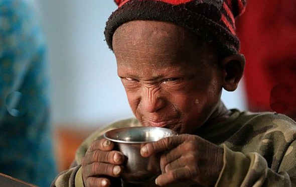 Küçük çocuk gün geçtikçe taşa dönüyor! - Resim: 3