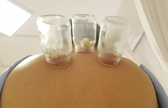 Hacamat hangi günler yapılır faydaları! Hacamat öncesi cinsel ilişki... - Resim: 1