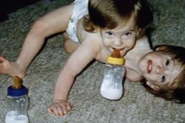 Tek bedende iki kardeş! Yaşamaz denilen mucizevi ikizler herkesi şoke etti - Resim: 3