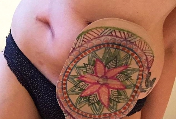 17 yaşında bağırsaklarını aldırdı: Yeni hayatına böyle başladı! - Resim: 3