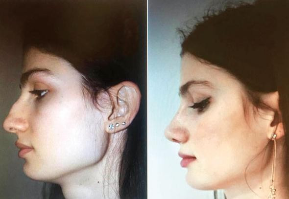 Burun farkıyla 1. demişlerdi estetik yaptırdı - Resim: 2