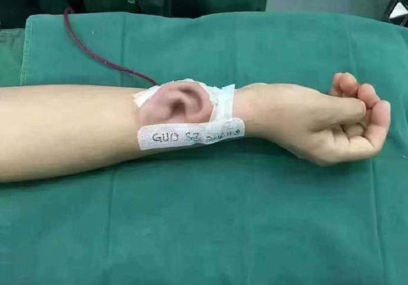 Kulağı tamamen parçalanmıştı mucize estetik - Resim: 1