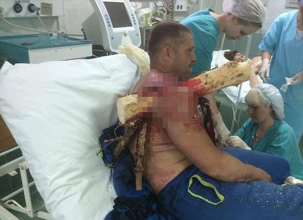 Dehşete düşüren manzara! Omzuna kütük saplandı - Resim: 1