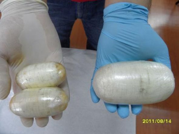 Bunlar onun cinsel organından çıktı - Resim: 1