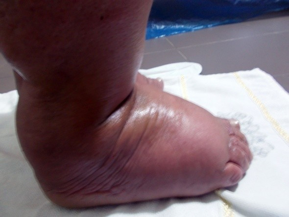 31 yıl sonra fil hastalığını yendi - Resim: 1