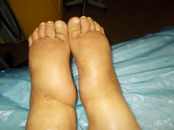 31 yıl sonra fil hastalığını yendi - Resim: 2