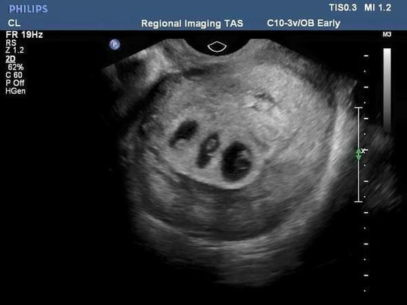 Karnı sürekli büyüyordu! Ultrasona girence şok oldu... - Resim: 2