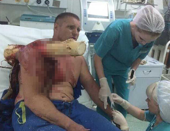 Dehşete düşüren manzara! Omzuna kütük saplandı - Resim: 3