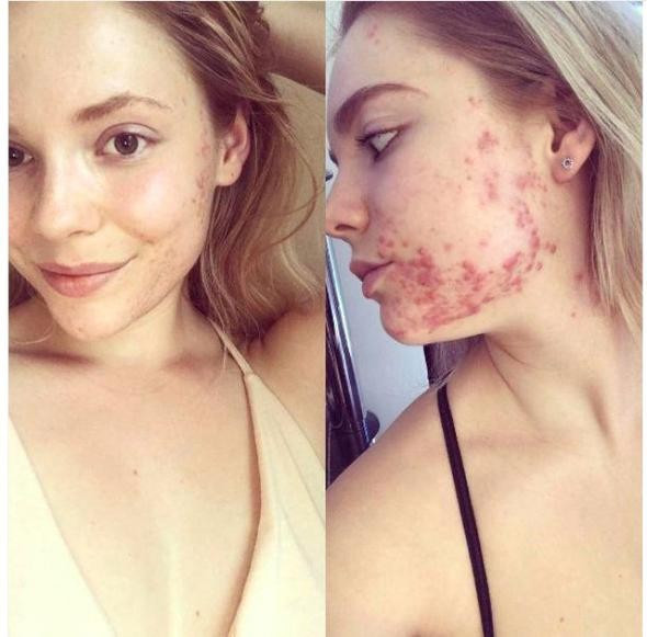 Hayatından tek bir besini çıkardı sivilcelerden kurtuldu - Resim: 3