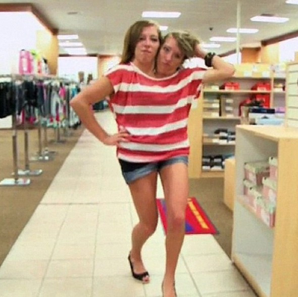 Onlar tek beden de iki ayrı dünya yapışık ikizler dünyayı şaşırttı - Resim: 4