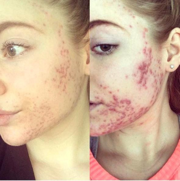 Hayatından tek bir besini çıkardı sivilcelerden kurtuldu - Resim: 4