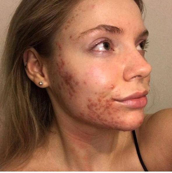 Hayatından tek bir besini çıkardı sivilcelerden kurtuldu - Resim: 1