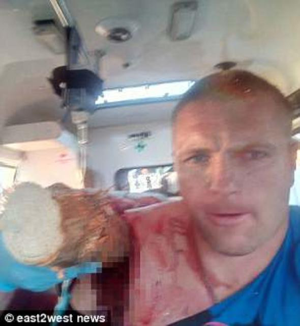 Dehşete düşüren manzara! Omzuna kütük saplandı - Resim: 4